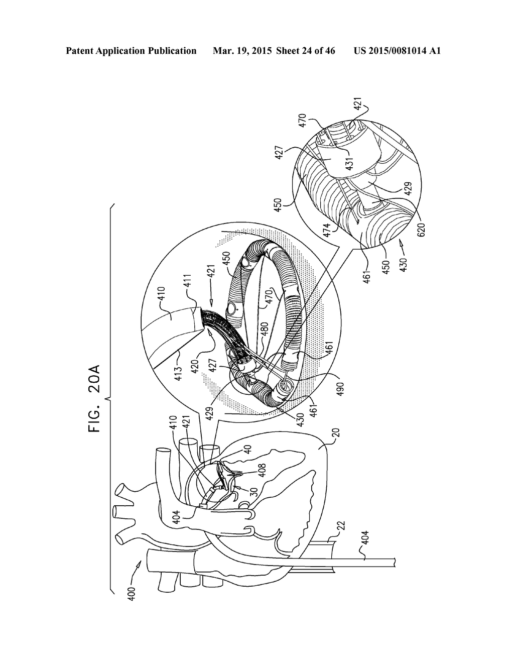 IMPLANT AND ANCHOR PLACEMENT - diagram, schematic, and image 25