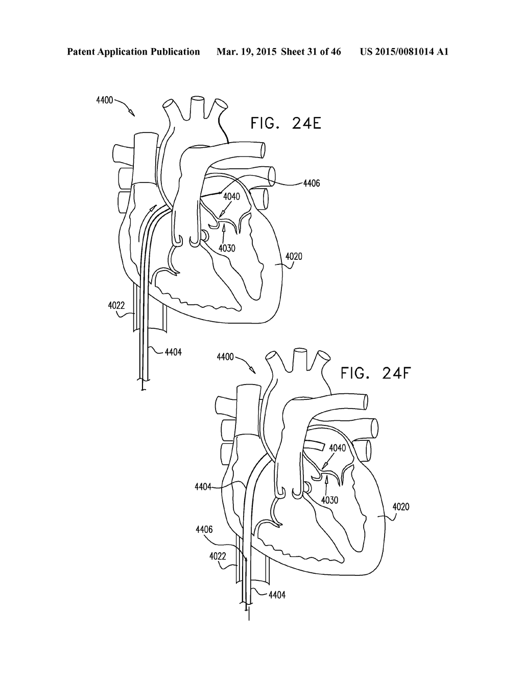 IMPLANT AND ANCHOR PLACEMENT - diagram, schematic, and image 32