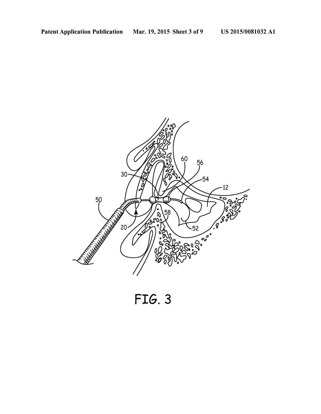 DEVICE FOR MAINTAINING PATENT PARANASAL SINUS OSTIA - diagram, schematic, and image 04