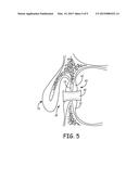 DEVICE FOR MAINTAINING PATENT PARANASAL SINUS OSTIA diagram and image
