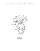 STENTED VASCULAR GRAFT diagram and image