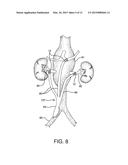 STENTED VASCULAR GRAFT diagram and image