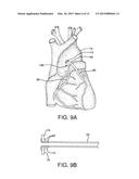 STENTED VASCULAR GRAFT diagram and image
