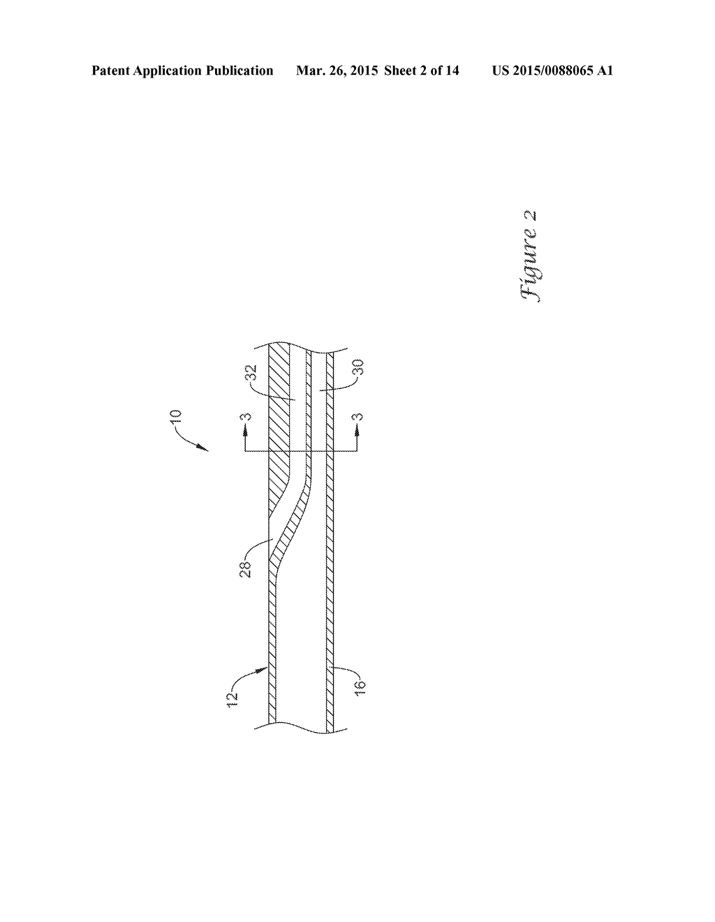 CATHETER INCLUDING A BARE METAL HYPOTUBE - diagram, schematic, and image 03