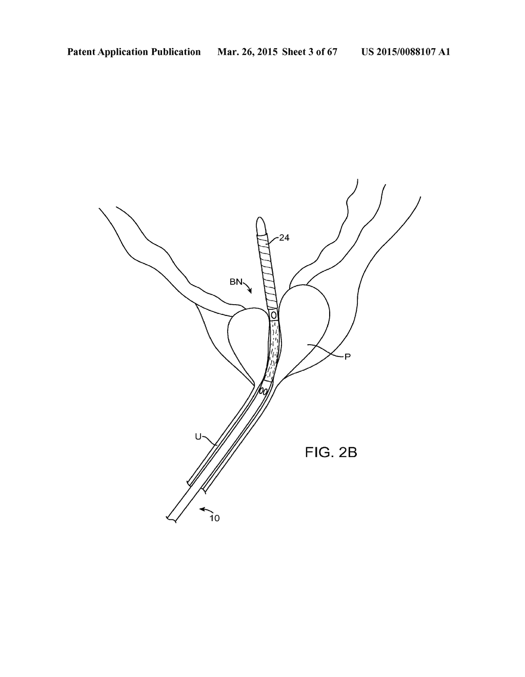 AUTOMATED IMAGE-GUIDED TISSUE RESECTION AND TREATMENT - diagram, schematic, and image 04