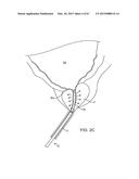 AUTOMATED IMAGE-GUIDED TISSUE RESECTION AND TREATMENT diagram and image