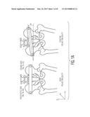 METHOD FOR ALIGNING AN ACETABULAR CUP diagram and image