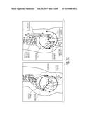 METHOD FOR ALIGNING AN ACETABULAR CUP diagram and image