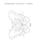 METHOD FOR ALIGNING AN ACETABULAR CUP diagram and image