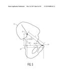 METHOD FOR ALIGNING AN ACETABULAR CUP diagram and image