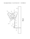 METHOD FOR ALIGNING AN ACETABULAR CUP diagram and image