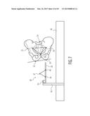 METHOD FOR ALIGNING AN ACETABULAR CUP diagram and image