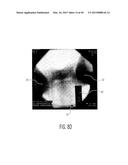 METHOD FOR ALIGNING AN ACETABULAR CUP diagram and image