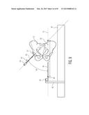 METHOD FOR ALIGNING AN ACETABULAR CUP diagram and image