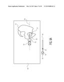 METHOD FOR ALIGNING AN ACETABULAR CUP diagram and image