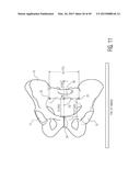 METHOD FOR ALIGNING AN ACETABULAR CUP diagram and image