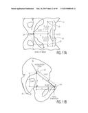 METHOD FOR ALIGNING AN ACETABULAR CUP diagram and image