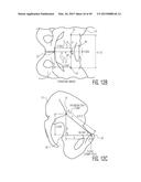 METHOD FOR ALIGNING AN ACETABULAR CUP diagram and image