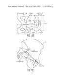 METHOD FOR ALIGNING AN ACETABULAR CUP diagram and image