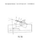 METHOD FOR ALIGNING AN ACETABULAR CUP diagram and image