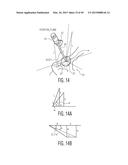 METHOD FOR ALIGNING AN ACETABULAR CUP diagram and image