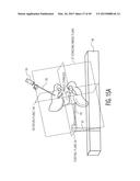 METHOD FOR ALIGNING AN ACETABULAR CUP diagram and image