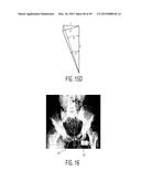 METHOD FOR ALIGNING AN ACETABULAR CUP diagram and image