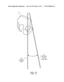 METHOD FOR ALIGNING AN ACETABULAR CUP diagram and image