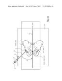 METHOD FOR ALIGNING AN ACETABULAR CUP diagram and image