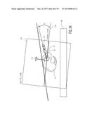 METHOD FOR ALIGNING AN ACETABULAR CUP diagram and image