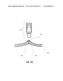 METHODS, DEVICES AND SYSTEMS FOR APPROXIMATION AND FASTENING OF SOFT     TISSUE diagram and image