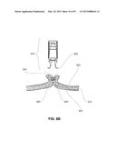 METHODS, DEVICES AND SYSTEMS FOR APPROXIMATION AND FASTENING OF SOFT     TISSUE diagram and image