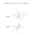 METHODS, DEVICES AND SYSTEMS FOR APPROXIMATION AND FASTENING OF SOFT     TISSUE diagram and image