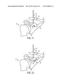 Methods and Devices for Passing Sutures Around Anatomical Structures diagram and image