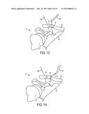 Methods and Devices for Passing Sutures Around Anatomical Structures diagram and image