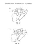 Methods and Devices for Passing Sutures Around Anatomical Structures diagram and image