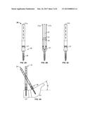 LUMBAR-SACRAL SCREW INSERTION AND MANIPULATION diagram and image