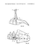 LUMBAR-SACRAL SCREW INSERTION AND MANIPULATION diagram and image