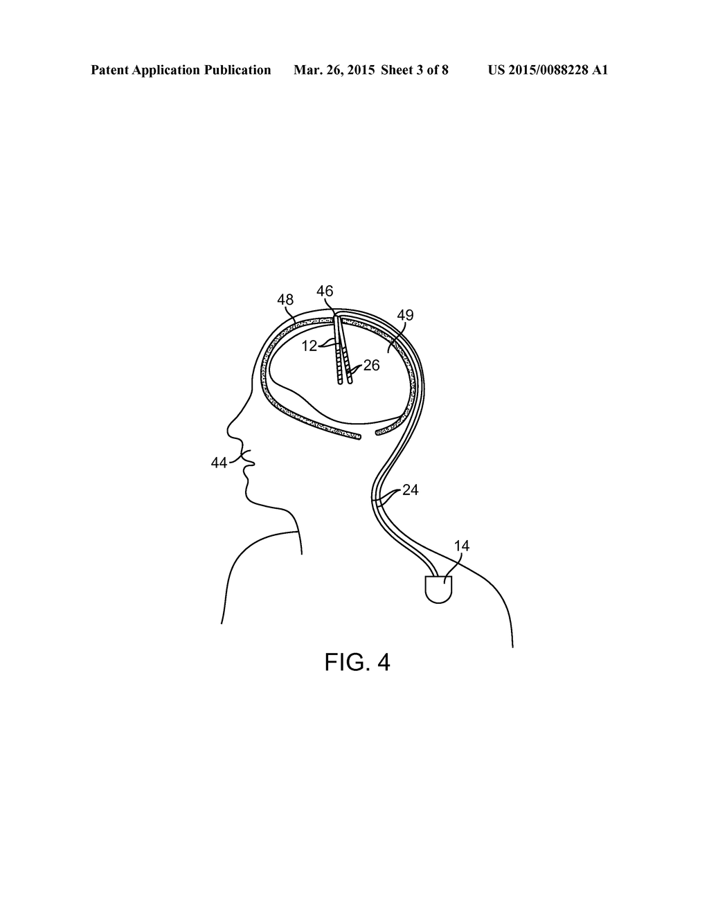 NEUROSTIMULATION SYSTEM FOR SELECTIVELY ESTIMATING VOLUME OF ACTIVATION     AND PROVIDING THERAPY - diagram, schematic, and image 04