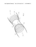 METHODS FOR TREATING ABNORMAL GROWTHS IN THE BODY USING A FLOW REDUCING     IMPLANT diagram and image