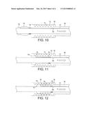 Transluminal Delivery System diagram and image