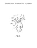 STENTED VASCULAR GRAFT diagram and image