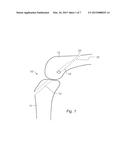 IMPLANTATION ASSEMBLY FOR A PROSTHETIC LIGAMENT diagram and image