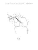 IMPLANTATION ASSEMBLY FOR A PROSTHETIC LIGAMENT diagram and image