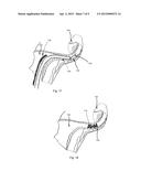 OCCLUSION OF FALLOPIAN TUBES IN VERTEBRATE SUBJECT diagram and image