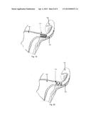 OCCLUSION OF FALLOPIAN TUBES IN VERTEBRATE SUBJECT diagram and image