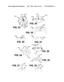 COLLECTION AND FILTRATION VIA SUCTION OF BIOLOGICAL MATERIAL DURING     SURGICAL PROCEDURE diagram and image