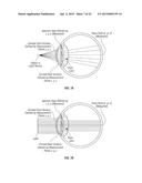 SYSTEMS AND METHODS FOR IMPLANTING AND EXAMINING INTRAOCULAR LENS diagram and image