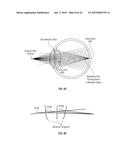 SYSTEMS AND METHODS FOR IMPLANTING AND EXAMINING INTRAOCULAR LENS diagram and image
