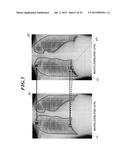 THORACIC DIAGNOSIS ASSISTANCE SYSTEM AND COMPUTER READABLE STORAGE MEDIUM diagram and image